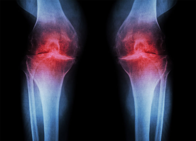 Knee Osteoarthritis